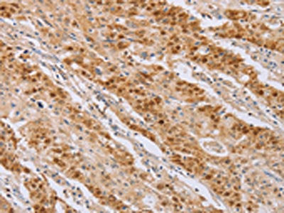 The image on the left is immunohistochemistry of paraffin-embedded Human gastic cancer tissue using CSB-PA243587(MCM5 Antibody) at dilution 1/40, on the right is treated with fusion protein. (Original magnification: ×200)