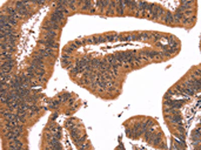 The image on the left is immunohistochemistry of paraffin-embedded Human colon cancer tissue using CSB-PA243625(FAIM Antibody) at dilution 1/25, on the right is treated with synthetic peptide. (Original magnification: ×200)