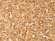The image on the left is immunohistochemistry of paraffin-embedded Human liver cancer tissue using CSB-PA243656(COLEC11 Antibody) at dilution 1/20, on the right is treated with fusion protein. (Original magnification: ×200)