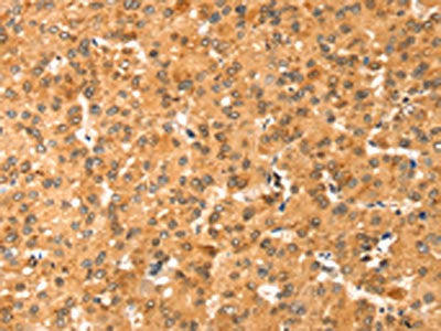 The image on the left is immunohistochemistry of paraffin-embedded Human liver cancer tissue using CSB-PA243656(COLEC11 Antibody) at dilution 1/20, on the right is treated with fusion protein. (Original magnification: ×200)