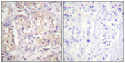 Immunohistochemical analysis of paraffin-embedded human breast carcinoma tissue using B-Raf (Phospho-Thr598) antibody (left)or the same antibody preincubated with blocking peptide (right).