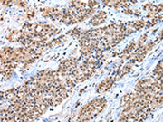 The image on the left is immunohistochemistry of paraffin-embedded Human breast cancer tissue using CSB-PA243683(CTBP1 Antibody) at dilution 1/30, on the right is treated with synthetic peptide. (Original magnification: ×200)