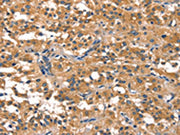 The image on the left is immunohistochemistry of paraffin-embedded Human thyroid cancer tissue using CSB-PA243767(EIF4G1 Antibody) at dilution 1/30, on the right is treated with synthetic peptide. (Original magnification: ×200)