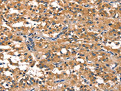The image on the left is immunohistochemistry of paraffin-embedded Human thyroid cancer tissue using CSB-PA243767(EIF4G1 Antibody) at dilution 1/30, on the right is treated with synthetic peptide. (Original magnification: ×200)