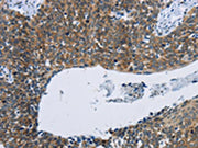 The image on the left is immunohistochemistry of paraffin-embedded Human cervical cancer tissue using CSB-PA244093(KPNB1 Antibody) at dilution 1/40, on the right is treated with synthetic peptide. (Original magnification: ×200)