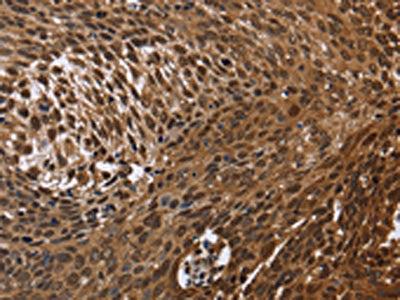 The image on the left is immunohistochemistry of paraffin-embedded Human cervical cancer tissue using CSB-PA244133(DCP1A Antibody) at dilution 1/50, on the right is treated with fusion protein. (Original magnification: ×200)