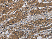 The image on the left is immunohistochemistry of paraffin-embedded Human gastic cancer tissue using CSB-PA244145(INPPL1 Antibody) at dilution 1/40, on the right is treated with synthetic peptide. (Original magnification: ×200)