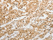 The image on the left is immunohistochemistry of paraffin-embedded Human lung cancer tissue using CSB-PA244200(GRIN2C Antibody) at dilution 1/100, on the right is treated with synthetic peptide. (Original magnification: ×200)