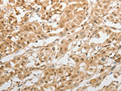 The image on the left is immunohistochemistry of paraffin-embedded Human lung cancer tissue using CSB-PA244200(GRIN2C Antibody) at dilution 1/100, on the right is treated with synthetic peptide. (Original magnification: ×200)