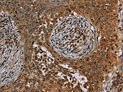 The image on the left is immunohistochemistry of paraffin-embedded Human cervical cancer tissue using CSB-PA244255(OSM Antibody) at dilution 1/40, on the right is treated with synthetic peptide. (Original magnification: ×200)