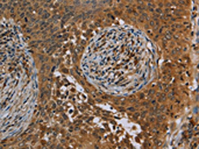 The image on the left is immunohistochemistry of paraffin-embedded Human cervical cancer tissue using CSB-PA244255(OSM Antibody) at dilution 1/40, on the right is treated with synthetic peptide. (Original magnification: ×200)