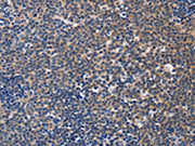 The image on the left is immunohistochemistry of paraffin-embedded Human Lymphoma tissue using CSB-PA244343(CCR6 Antibody) at dilution 1/50, on the right is treated with synthetic peptide. (Original magnification: ×200)