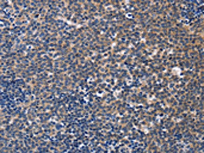 The image on the left is immunohistochemistry of paraffin-embedded Human Lymphoma tissue using CSB-PA244343(CCR6 Antibody) at dilution 1/50, on the right is treated with synthetic peptide. (Original magnification: ×200)