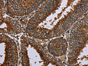 The image on the left is immunohistochemistry of paraffin-embedded Human colon cancer tissue using CSB-PA244365(C12orf75 Antibody) at dilution 1/20, on the right is treated with synthetic peptide. (Original magnification: ×200)