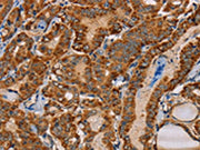 The image on the left is immunohistochemistry of paraffin-embedded Human thyroid cancer tissue using CSB-PA244510(MBNL3 Antibody) at dilution 1/30, on the right is treated with fusion protein. (Original magnification: ×200)