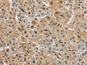 The image on the left is immunohistochemistry of paraffin-embedded Human liver cancer tissue using CSB-PA244536(NAPSA Antibody) at dilution 1/40, on the right is treated with fusion protein. (Original magnification: ×200)