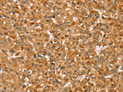 The image on the left is immunohistochemistry of paraffin-embedded Human liver cancer tissue using CSB-PA244550(STX3 Antibody) at dilution 1/35, on the right is treated with synthetic peptide. (Original magnification: ×200)