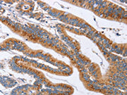 The image on the left is immunohistochemistry of paraffin-embedded Human colon cancer tissue using CSB-PA244590(SIGLEC6 Antibody) at dilution 1/60, on the right is treated with synthetic peptide. (Original magnification: ×200)