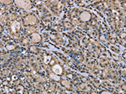 The image on the left is immunohistochemistry of paraffin-embedded Human thyroid cancer tissue using CSB-PA244606(DYNLL1 Antibody) at dilution 1/30, on the right is treated with fusion protein. (Original magnification: ×200)