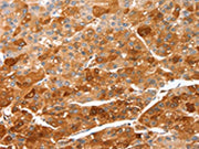 The image on the left is immunohistochemistry of paraffin-embedded Human liver cancer tissue using CSB-PA244699(CIDEC Antibody) at dilution 1/50, on the right is treated with fusion protein. (Original magnification: ×200)