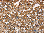 The image on the left is immunohistochemistry of paraffin-embedded Human thyroid cancer tissue using CSB-PA244825(CDC25A Antibody) at dilution 1/60, on the right is treated with synthetic peptide. (Original magnification: ×200)