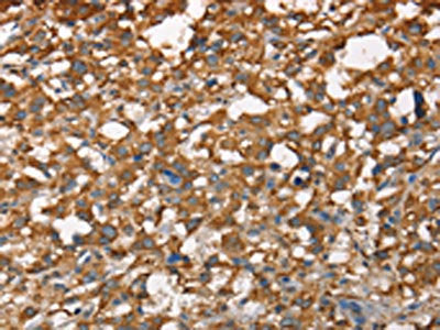 The image on the left is immunohistochemistry of paraffin-embedded Human thyroid cancer tissue using CSB-PA244825(CDC25A Antibody) at dilution 1/60, on the right is treated with synthetic peptide. (Original magnification: ×200)