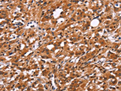 The image on the left is immunohistochemistry of paraffin-embedded Human thyroid cancer tissue using CSB-PA244891(SLC8A2 Antibody) at dilution 1/15, on the right is treated with synthetic peptide. (Original magnification: ×200)
