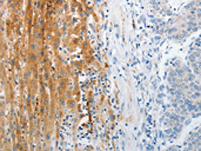 The image on the left is immunohistochemistry of paraffin-embedded Human liver cancer tissue using CSB-PA244928(TRPM1 Antibody) at dilution 1/30, on the right is treated with synthetic peptide. (Original magnification: ×200)