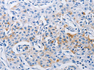 The image on the left is immunohistochemistry of paraffin-embedded Human lung cancer tissue using CSB-PA245012(LRIG1 Antibody) at dilution 1/120, on the right is treated with synthetic peptide. (Original magnification: ×200)