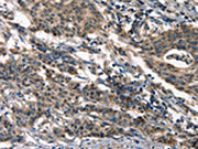 The image on the left is immunohistochemistry of paraffin-embedded Human gastic cancer tissue using CSB-PA245088(DEFA5 Antibody) at dilution 1/15, on the right is treated with synthetic peptide. (Original magnification: ×200)