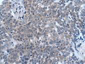 Immunohistochemistry of paraffin-embedded human thyroid cancer using CSB-PA245265 at dilution of 1:20