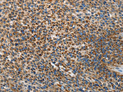 The image on the left is immunohistochemistry of paraffin-embedded Human liver cancer tissue using CSB-PA245266(UPF1 Antibody) at dilution 1/35, on the right is treated with synthetic peptide. (Original magnification: ×200)