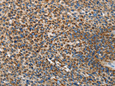 The image on the left is immunohistochemistry of paraffin-embedded Human liver cancer tissue using CSB-PA245266(UPF1 Antibody) at dilution 1/35, on the right is treated with synthetic peptide. (Original magnification: ×200)