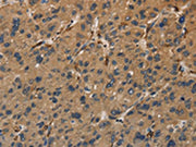 The image on the left is immunohistochemistry of paraffin-embedded Human liver cancer tissue using CSB-PA245297(UBE2S Antibody) at dilution 1/40, on the right is treated with fusion protein. (Original magnification: ×200)