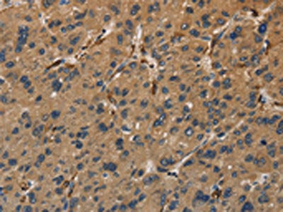 The image on the left is immunohistochemistry of paraffin-embedded Human liver cancer tissue using CSB-PA245297(UBE2S Antibody) at dilution 1/40, on the right is treated with fusion protein. (Original magnification: ×200)