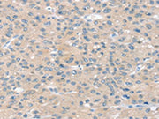 The image on the left is immunohistochemistry of paraffin-embedded Human liver cancer tissue using CSB-PA245341(SLIT2 Antibody) at dilution 1/30, on the right is treated with synthetic peptide. (Original magnification: ×200)