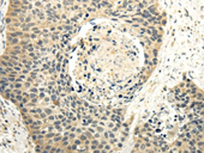 The image on the left is immunohistochemistry of paraffin-embedded Human esophagus cancer tissue using CSB-PA245350(MAP3K7 Antibody) at dilution 1/20, on the right is treated with fusion protein. (Original magnification: ×200)