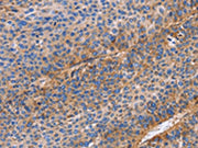 The image on the left is immunohistochemistry of paraffin-embedded Human liver cancer tissue using CSB-PA245433(ITGB1 Antibody) at dilution 1/60, on the right is treated with fusion protein. (Original magnification: ×200)