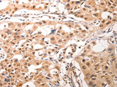The image on the left is immunohistochemistry of paraffin-embedded Human lung cancer tissue using CSB-PA245457(CDC6 Antibody) at dilution 1/25, on the right is treated with synthetic peptide. (Original magnification: ×200)