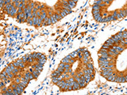 The image on the left is immunohistochemistry of paraffin-embedded Human colon cancer tissue using CSB-PA245851(GDF6 Antibody) at dilution 1/20, on the right is treated with synthetic peptide. (Original magnification: ×200)