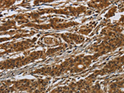 The image on the left is immunohistochemistry of paraffin-embedded Human gastic cancer tissue using CSB-PA245950(GATA5 Antibody) at dilution 1/50, on the right is treated with synthetic peptide. (Original magnification: ×200)