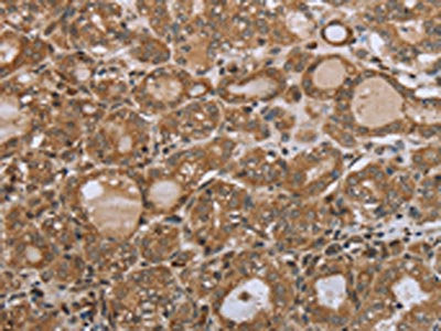 The image on the left is immunohistochemistry of paraffin-embedded Human thyroid cancer tissue using CSB-PA246122(NDUFS2 Antibody) at dilution 1/35, on the right is treated with synthetic peptide. (Original magnification: ×200)