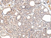 The image on the left is immunohistochemistry of paraffin-embedded Human thyroid cancer tissue using CSB-PA246201(VPS33A Antibody) at dilution 1/30, on the right is treated with fusion protein. (Original magnification: ×200)