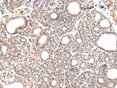The image on the left is immunohistochemistry of paraffin-embedded Human thyroid cancer tissue using CSB-PA246201(VPS33A Antibody) at dilution 1/30, on the right is treated with fusion protein. (Original magnification: ×200)