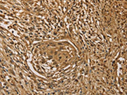 The image on the left is immunohistochemistry of paraffin-embedded Human cervical cancer tissue using CSB-PA246357(PRDM14 Antibody) at dilution 1/40, on the right is treated with fusion protein. (Original magnification: ×200)