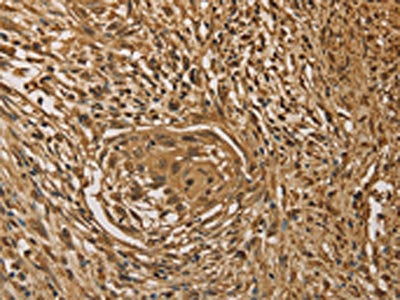 The image on the left is immunohistochemistry of paraffin-embedded Human cervical cancer tissue using CSB-PA246357(PRDM14 Antibody) at dilution 1/40, on the right is treated with fusion protein. (Original magnification: ×200)