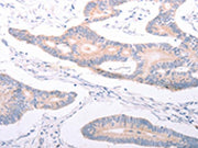 The image on the left is immunohistochemistry of paraffin-embedded Human colon cancer tissue using CSB-PA246386(ANKRA2 Antibody) at dilution 1/25, on the right is treated with synthetic peptide. (Original magnification: ×200)