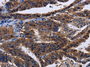 The image on the left is immunohistochemistry of paraffin-embedded Human gastic cancer tissue using CSB-PA246438(HTR2B Antibody) at dilution 1/60, on the right is treated with fusion protein. (Original magnification: ×200)