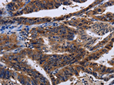 The image on the left is immunohistochemistry of paraffin-embedded Human gastic cancer tissue using CSB-PA246438(HTR2B Antibody) at dilution 1/60, on the right is treated with fusion protein. (Original magnification: ×200)