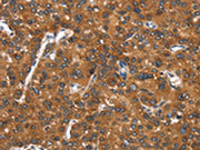 The image on the left is immunohistochemistry of paraffin-embedded Human liver cancer tissue using CSB-PA246478(CADM4 Antibody) at dilution 1/25, on the right is treated with synthetic peptide. (Original magnification: ×200)